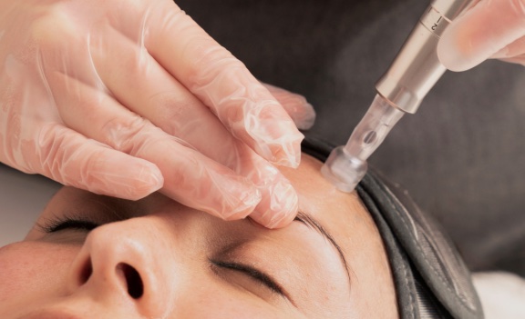 PRO-microneedling-available-now2-576x1024 copy